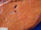 Wolman disease in liver