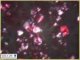 Wolman disease in liver