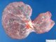 Bilobar placenta with central insertion of the umbilical cord