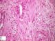 Colonic localization of an infantile myofibromatosis