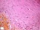 Cutaneous GVH