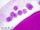 hydatid cyst : laminated and germinal membranes, with protoscolices