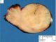 Mediastinal intermixed ganglioneuroblastoma