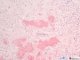 renomedullary interstitial cell tumor