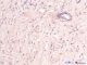 renomedullary interstitial cell tumor