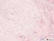 renomedullary interstitial cell tumor