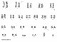 t(2;5)(p23;q35) creating NPM1/ALK fusion protein