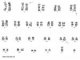 t(2;5)(p23;q35) creating NPM1/ALK fusion gene