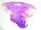 Nodal caseous necrosis in mycobacterial adenitis with cutaneous (...)