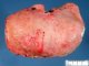 Cholestatic cirrhosis in extra-hepatic biliary tract atresia
