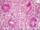 Acute colonic cryptitis in Crohn disease