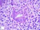 Acute colonic cryptitis in Crohn disease