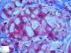 Gylogen storage disease type 4 (GSD4)