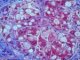Gylogen storage disease type 4 (GSD4)