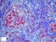 Gylogen storage disease type 4 (GSD4)