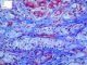 Gylogen storage disease type 4 (GSD4)