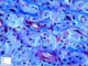 Gylogen storage disease type 4 (GSD4)