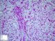 Gylogen storage disease type 4 (GSD4)