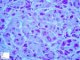 Gylogen storage disease type 4 (GSD4)