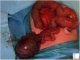 Intestinal duplication