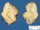 Lipoblastoma