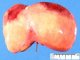 Liver ischemia in neonatal shock with DIVC