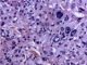 Paratesticular Leydig cell tumor