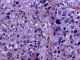 Paratesticular Leydig cell tumor