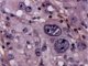 Paratesticular Leydig cell tumor
