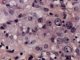 Paratesticular Leydig cell tumor