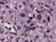 Paratesticular Leydig cell tumor