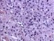 Paratesticular Leydig cell tumor