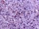 Paratesticular Leydig cell tumor