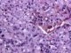 Paratesticular Leydig cell tumor