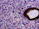 Paratesticular Leydig cell tumor