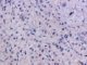 Paratesticular Leydig cell tumor