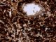 Paratesticular Leydig cell tumor