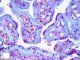 placental mucolipidosis