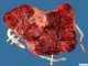 Triple pregnancy placenta