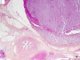 Renal hilum invasion