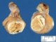 Testicular dermoid cyst