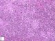 mixed cellularity Hodgkin lymphoma