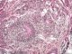 Neuroectodermal tissue in immature ovarian teratoma (6 years)