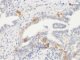 pagetoid spread : c-kit IHC