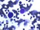 Parvovirus B19 cytopathogenic effect in bone marrow