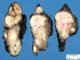 Thyroid papillary carcinoma