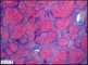 Micronodular cirrhosis in lysosomal acid lipase deficiency