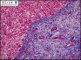 Wolman disease in liver