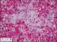 Wolman disease in liver