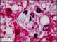Wolman disease in liver